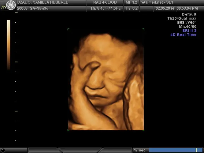 Ultrassom 3D face Fetal - 35a semana de gravidez | Fetalmed