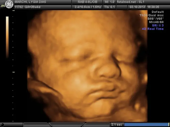 Ultrassom 3D face Fetal - 36a semana de gravidez | Fetalmed