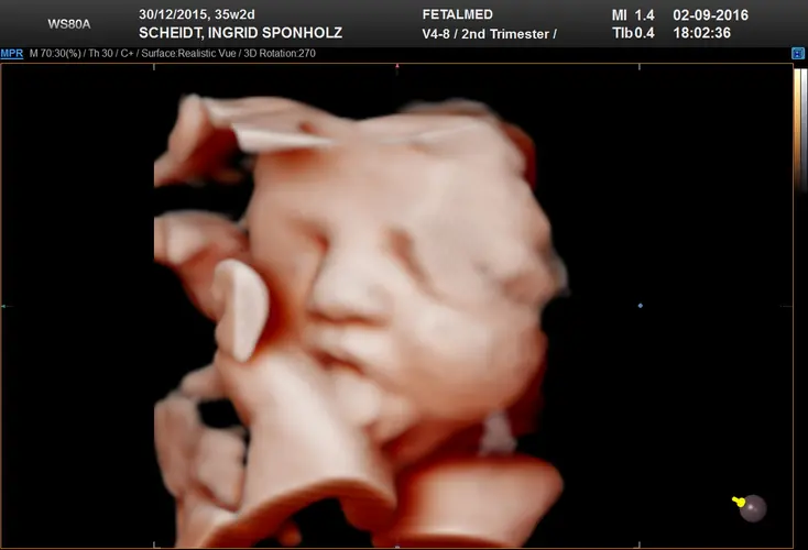 Ultrassom 3D face Fetal - 37a semana de gravidez | Fetalmed