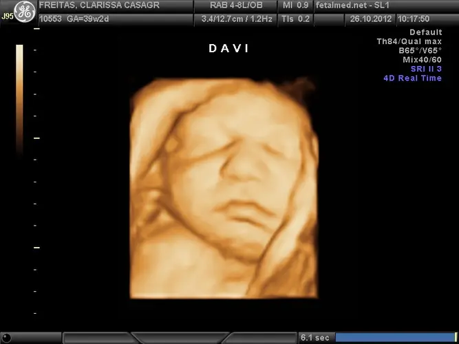 Face Fetal Ultrassom 3D - 39a semana de gravidez | Fetalmed