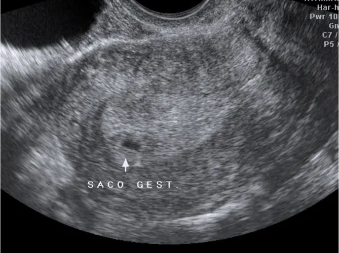 Ultrassom com 4 semanas de gestação - 4a semana de gravidez | Fetalmed