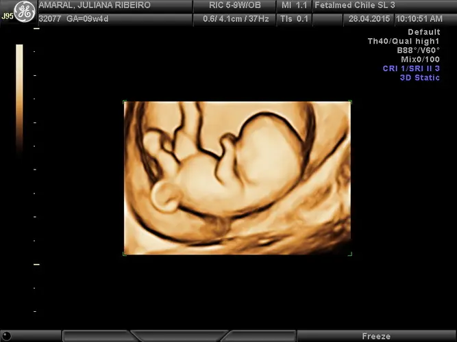 Ultrassom 3D de Embrião de 9 semanas - 9a semana de gravidez | Fetalmed