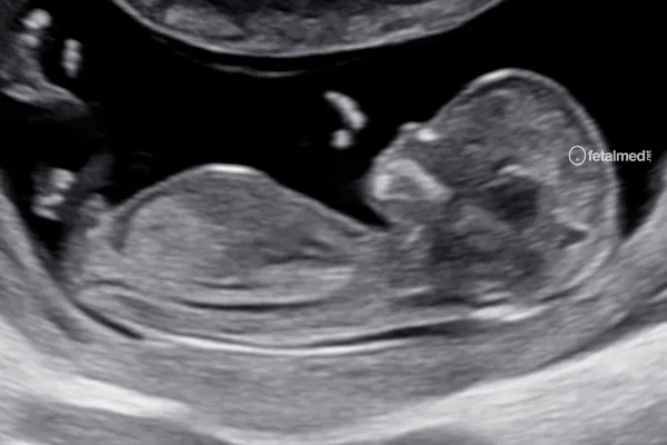 Tabela de translucência nucal por comprimento cabeça-nádega