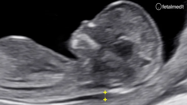 Medida da translucência nucal ao ultrassom no primeiro trimestre da gestação