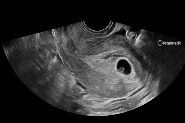 Tabela de saco gestacional, CCN e beta-hCG no primeiro trimestre