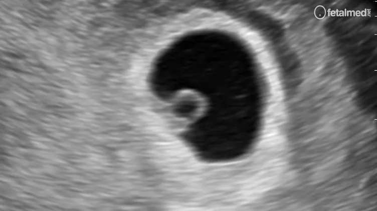 Saco gestacional com vesícula vitelínica ao ultrassom transvaginal no início da gestação