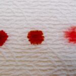 Sangramento na Gravidez — Descolamento do Saco Gestacional