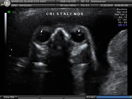 Tabela de biometria ocular fetal por idade gestacional