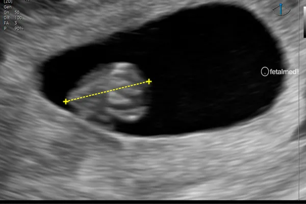 Tabela de comprimento cabeça-nádega (CCN) por idade gestacional