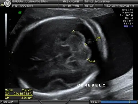 Tabela de diâmetro cerebelar e cisterna magna por idade gestacional