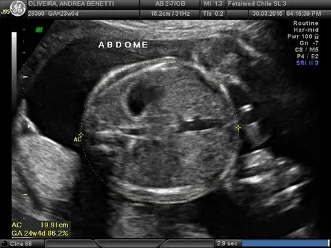 Tabela de circunferência abdominal e torácica fetal por idade gestacional