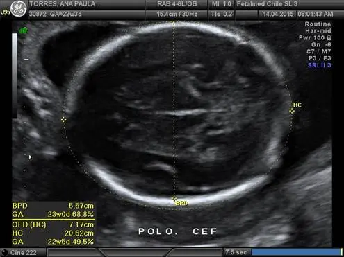 Tabela de diâmetro biparietal, circunferência cefálica e ventrículo lateral por idade gestacional