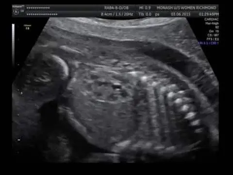 Tabela de diâmetro renal fetal por idade gestacional