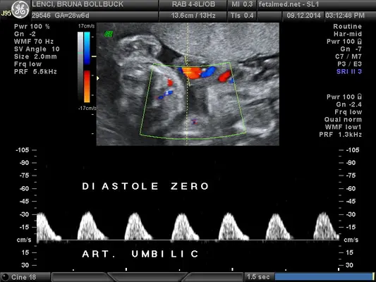 Tabela de Doppler das artérias umbilicais: índice de resistência e pulsatilidade por idade gestacional