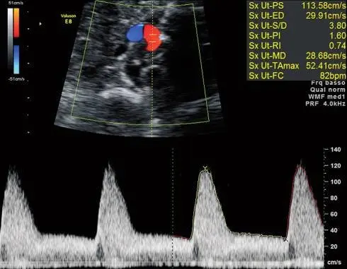 Tabela de Doppler das artérias uterinas: índice de pulsatilidade por idade gestacional
