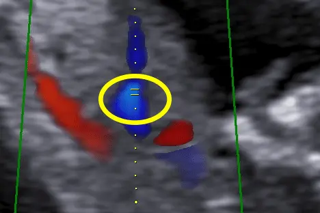 Tabela de Doppler do ducto venoso: índice de pulsatilidade por idade gestacional