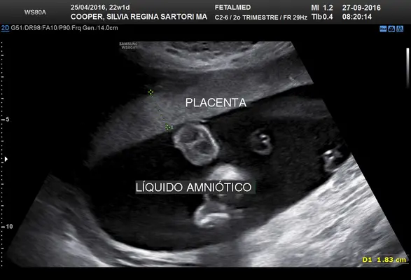 Tabela de espessura placentária por idade gestacional