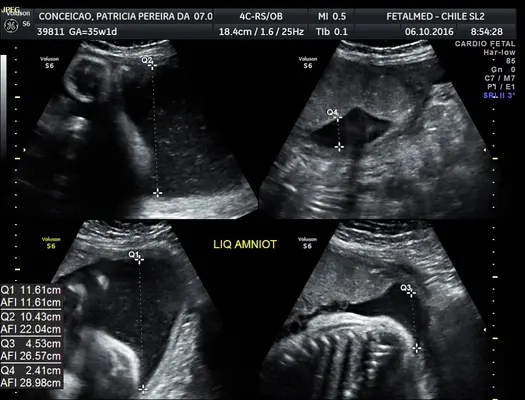 Tabela de índice de líquido amniótico (ILA) por idade gestacional