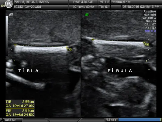 Tabela de membros inferiores fetais: fêmur, tíbia e fíbula por idade gestacional