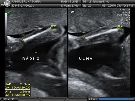 Tabela de membros superiores fetais: úmero, rádio e ulna por idade gestacional