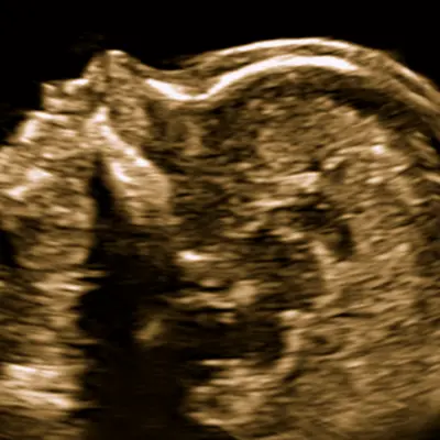 Tabela de osso nasal fetal segundo Mazzoni 2006