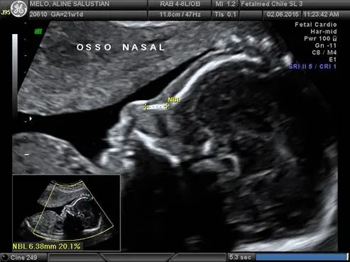 Tabela de osso nasal fetal segundo Sonek 2003