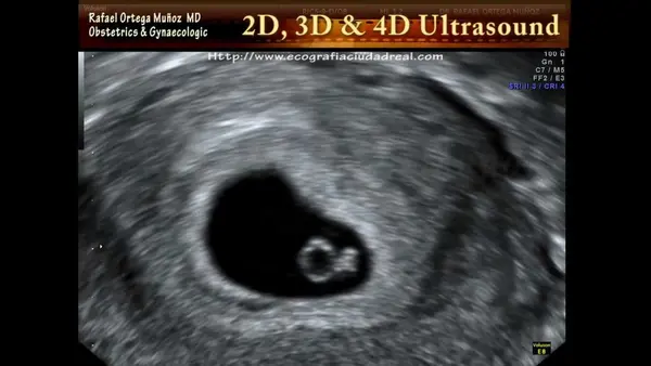 Relação entre saco gestacional, CCN e beta-hCG na gestação inicial