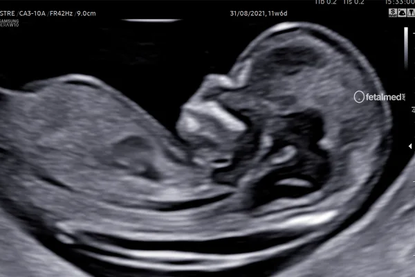 Medida da translucência nucal por ultrassom no primeiro trimestre da gestação