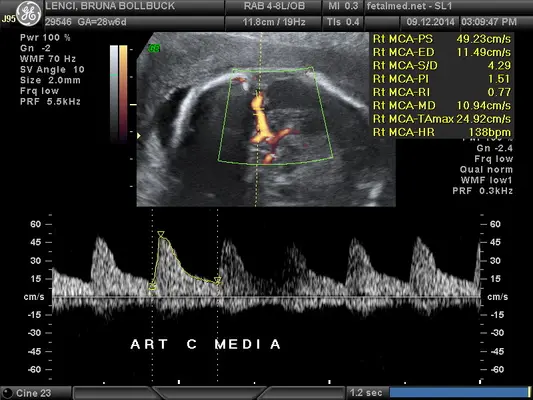 Tabela de velocidade de pico sistólico da artéria cerebral média para rastreio de anemia fetal