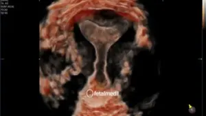 Ultrassonografia 3D pelvica com reconstrucao tridimensional do utero - exame ginecologico avancado na Fetalmed Curitiba