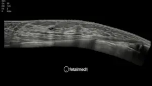 Ultrassonografia das mamas - exame mamario por ultrassom para rastreamento e diagnostico na Fetalmed Curitiba