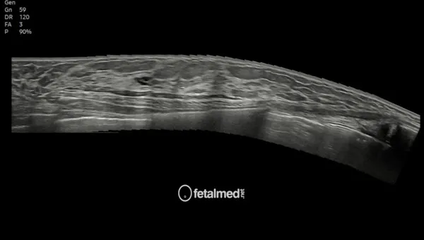 Ultrassonografia das mamas - exame mamario por ultrassom para rastreamento e diagnostico na Fetalmed Curitiba