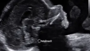 Ultrassonografia obstetrica com avaliacao de estruturas fetais - acompanhamento pre-natal por ultrassom na Fetalmed Curitiba