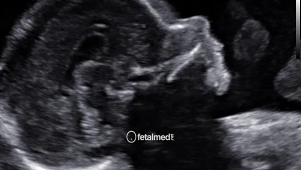 Ultrassonografia obstetrica com avaliacao de estruturas fetais - acompanhamento pre-natal por ultrassom na Fetalmed Curitiba