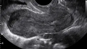 Ultrassonografia transvaginal pelvica - exame ginecologico por ultrassom para avaliacao uterina e ovariana na Fetalmed Curitiba