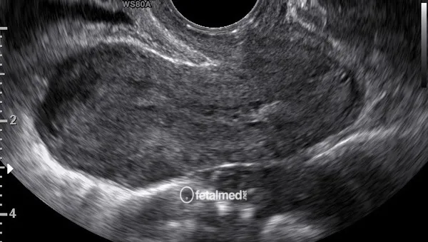 Ultrassonografia transvaginal pelvica - exame ginecologico por ultrassom para avaliacao uterina e ovariana na Fetalmed Curitiba