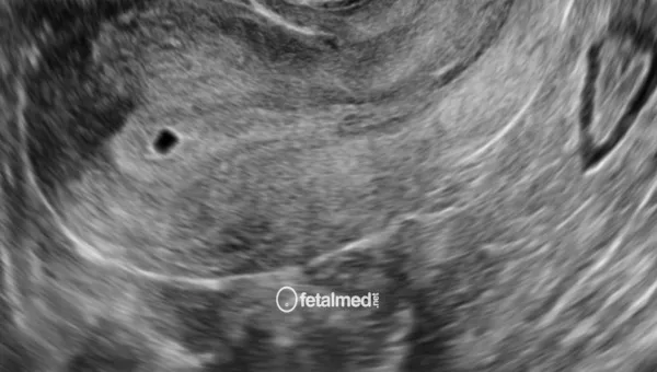 Ultrassonografia transvaginal de primeiro trimestre com visualizacao do saco gestacional - exame pre-natal inicial na Fetalmed Curitiba